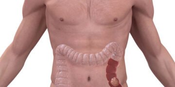 Cáncer de colon en menores de 50 años: conocé cómo evitarlo