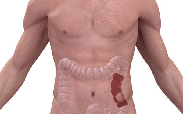 Cáncer de colon en menores de 50 años: conocé cómo evitarlo